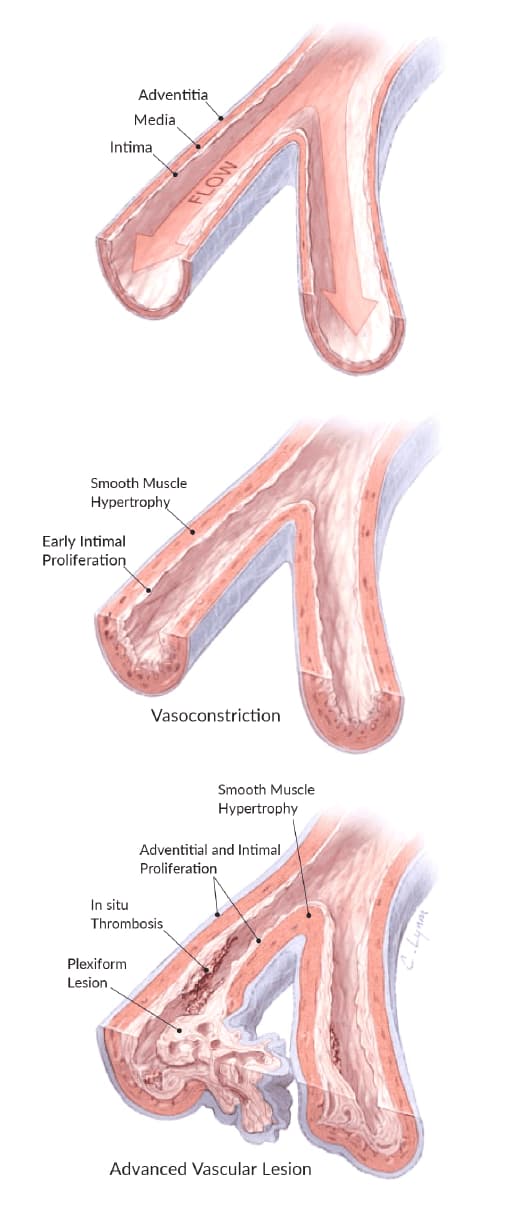 Diagram showing vasoconstriction and advanced vascular lesion