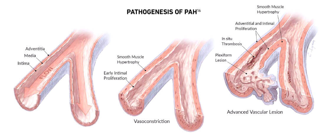Diagram showing pathoggenesis of PAH